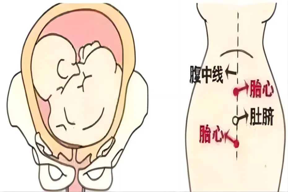 横位的胎心位置示意图