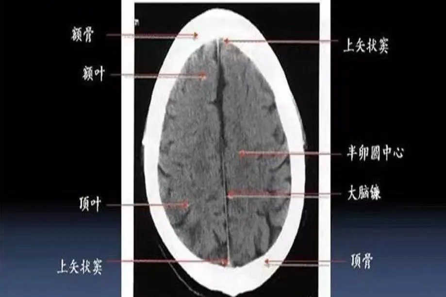 头颅ct断层解剖图