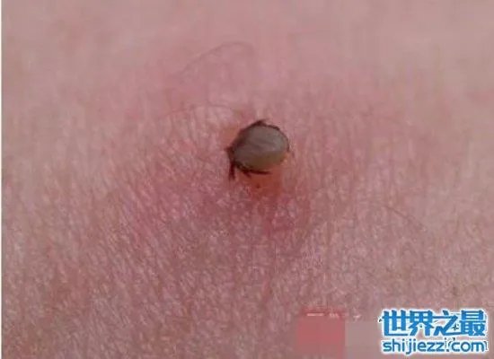 可怕!蜱虫叮咬后伤口图片竟是这样,咬伤后必须恰当处理! ...