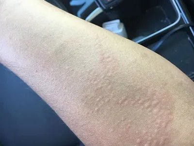慢性湿疹小红疙瘩图片