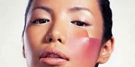 脸上的红血丝怎样处理