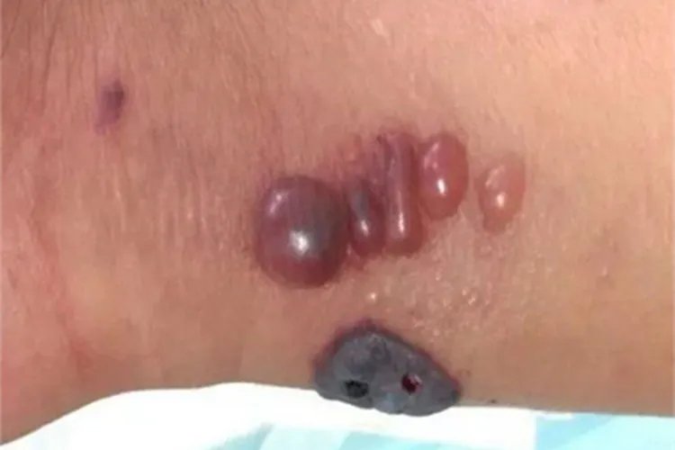 炭疽病症状图片