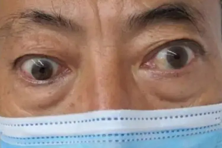 眼球突出与正常眼图片