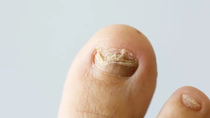 引起灰指甲的原因有什么