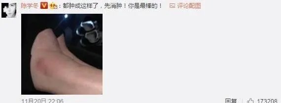 2017维密大秀,超模奚梦瑶不慎摔倒,未来的道路会如何?