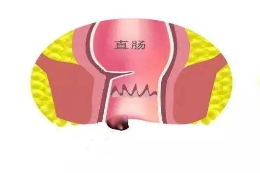轻微痔疮图片能自愈吗