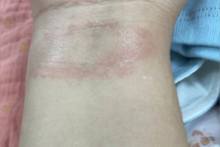 远心性环状红斑手腕症状图片
