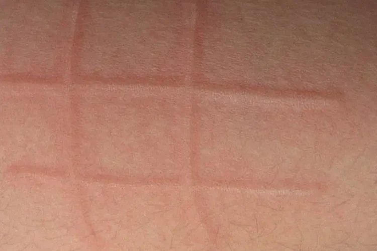荨麻疹性皮炎症状图片