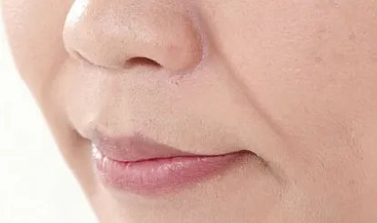 玻尿酸填充鼻唇沟整形的费用