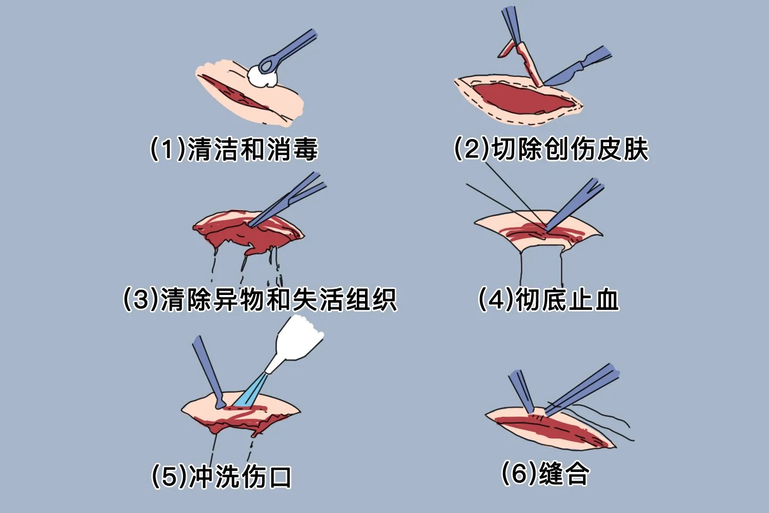 清创是什么意思图片大全