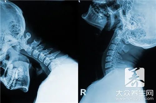 颈椎病保健体操怎么做
