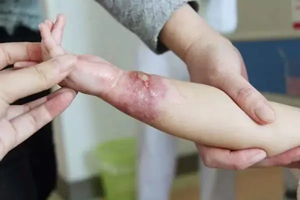 河南郑州9个月婴儿被开水烫伤，妈妈割皮救女，女婴是否能恢复如初？