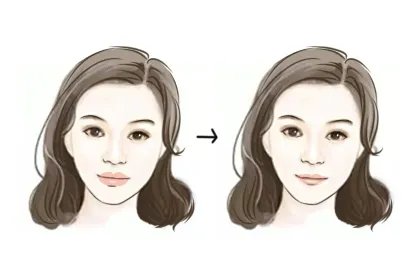 整容嘴唇变薄效果图