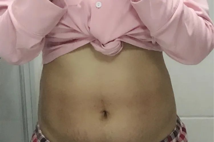 顺产完的肚子图片
