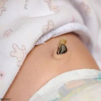 新生儿脐炎是怎么引起的