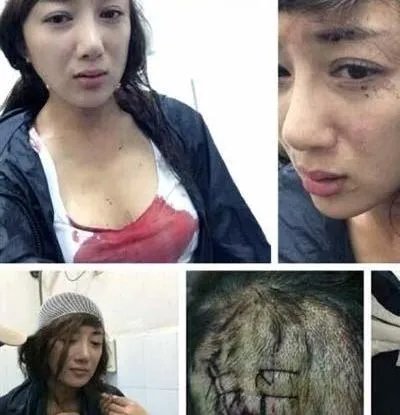 李依晓被咬事件始末以及被咬后的惨状图