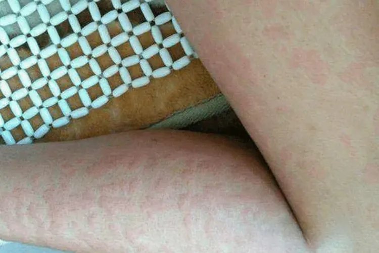 火龙果过敏症状图片大全